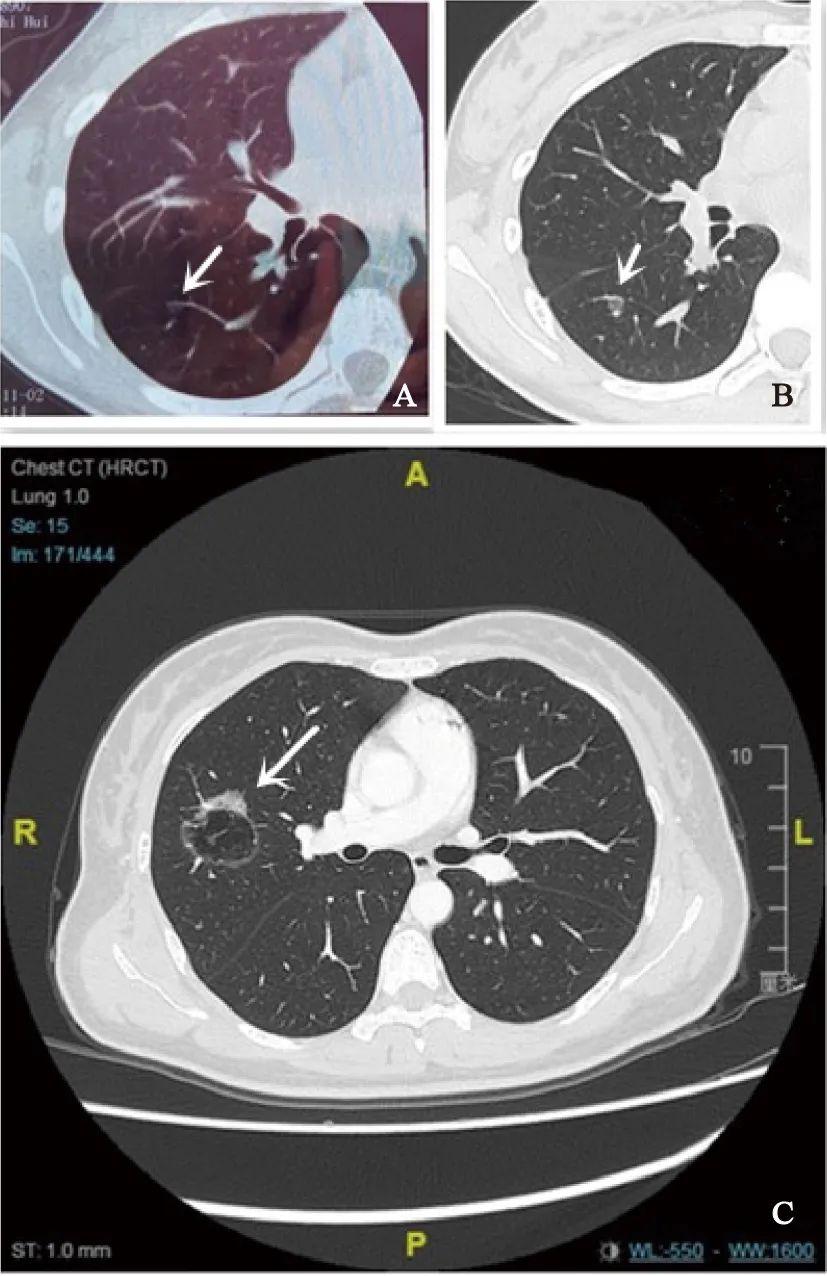 肺癌ct图片 片子图片